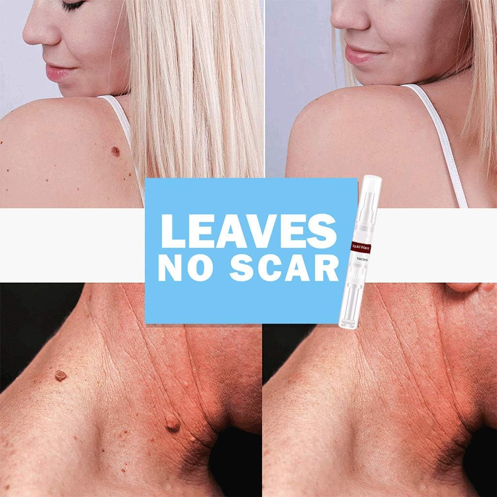 skin tag remover pen liquid wart remover